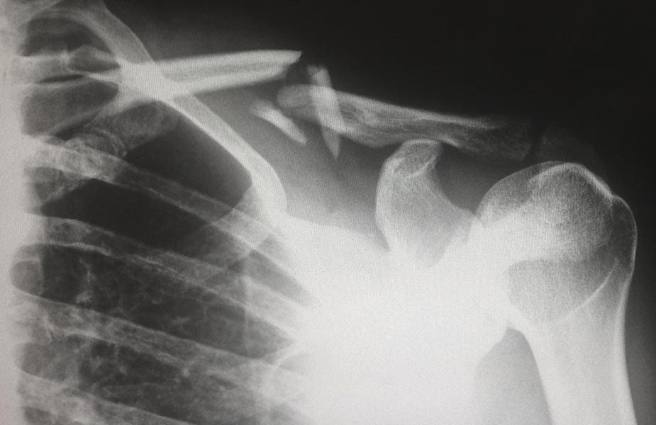 x-ray foto van een schouder