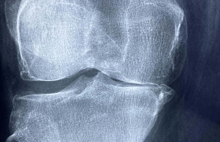 Knie met letselschade